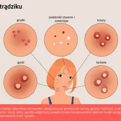 Ilustracja przedstawia różne rodzaje trądziku, w tym krosty, grudki i guzki, które mogą pojawić się na skórze.