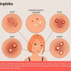 Ilustracja przedstawia różne rodzaje zaskórników i wyprysków trądzikowych: grudki, guzki, zaskórniki otwarte i zamknięte, krosty i torbiele.