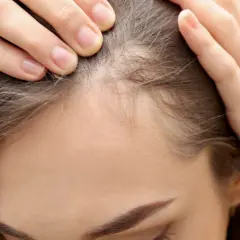 Delikatne baby hair na skroniach kobiety, która dotyka swojej głowy, szukając oznak odrastania włosów.