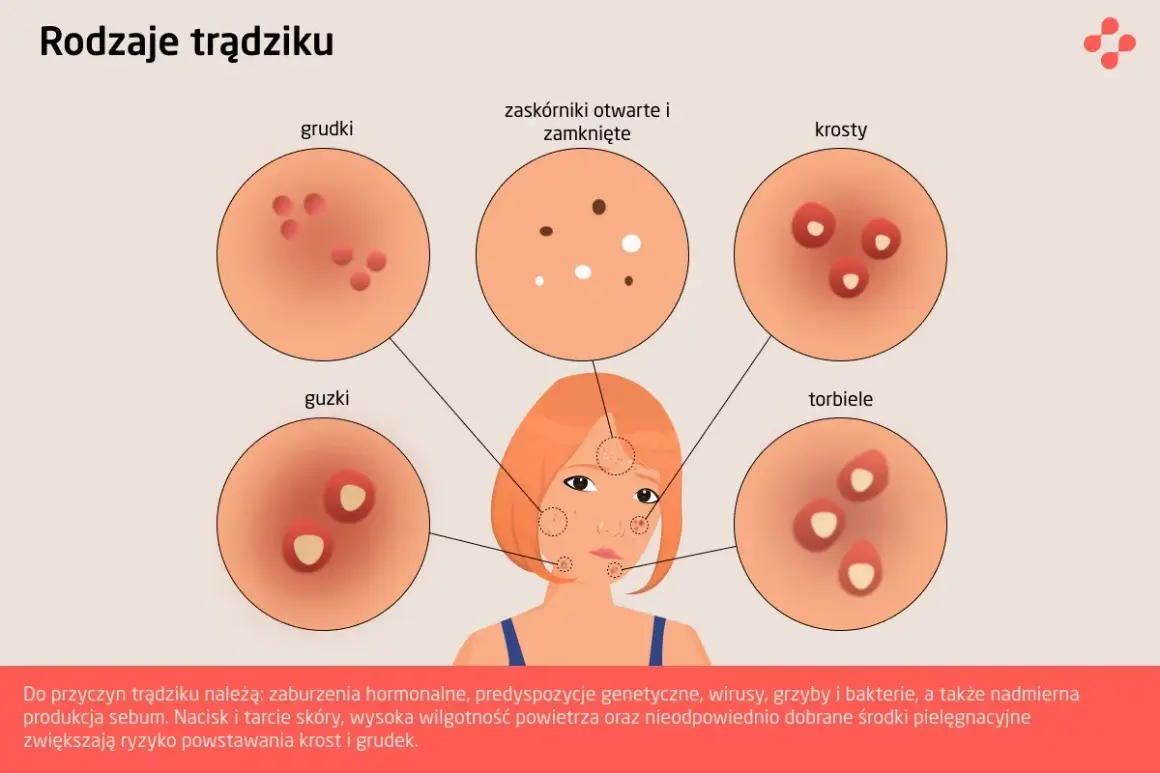 Ilustracja przedstawia różne rodzaje trądziku, w tym krosty, grudki i guzki, które mogą pojawić się na skórze.