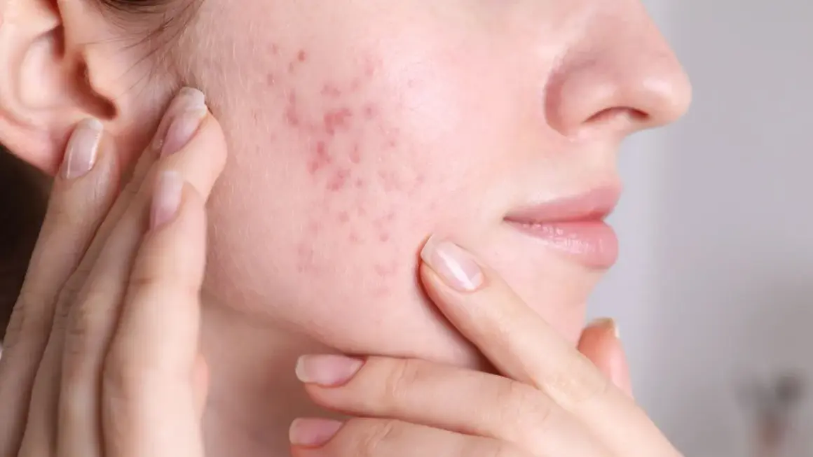 Skóra z zaczerwienionymi zmianami, przypominającymi trądzik grzybiczy. Dłonie delikatnie dotykają policzka, podkreślając problem.