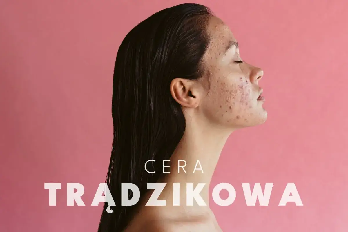 Kobieta z cerą trądzikową, która pokazuje codzienna pielęgnacja twarzy trądzikowej.